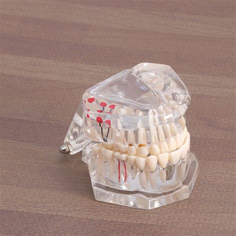 Buy BESTONZON Detachable Oral Model Removable Dental Implant Disease ...