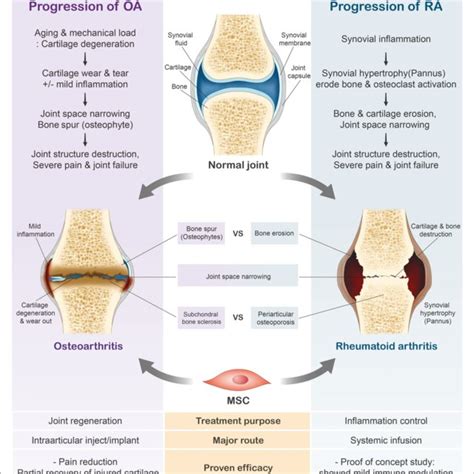 | Progression of rheumatoid arthritis (RA) and osteoarthritis (OA). In ...