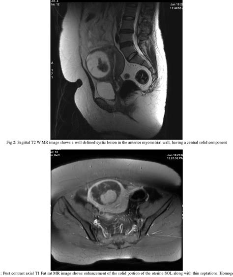 Figure 2 from Cystic Degeneration of Uterine Fibroid Mimicking a ...