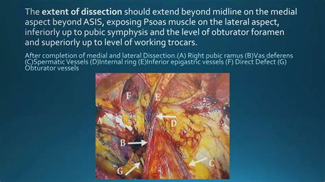 Laparoscopic repair of hernia- A Guide to Laparoscopic Hernia Surgery ...