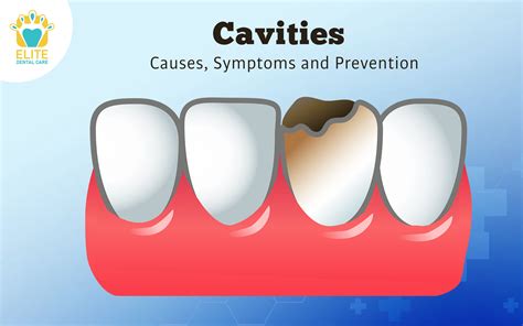 6. Cavities Causes Symptoms and Prevention - Elite Dental Care