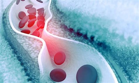 Sonolysis Reduces CV Events During Carotid Endarterectomy: Insights ...