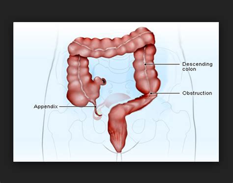 Image result for Appendicitis