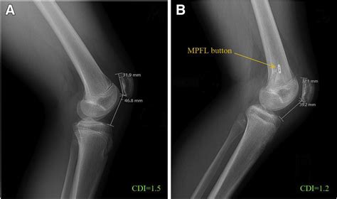 Patellar Tendon Imbrication for the Treatment of Patella Alta in ...