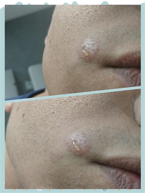 Flat Pimples On Face
