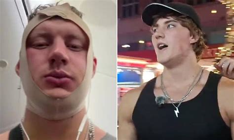 'Looksmaxxer' influencer is kicked off plane after undergoing cosmetic ...