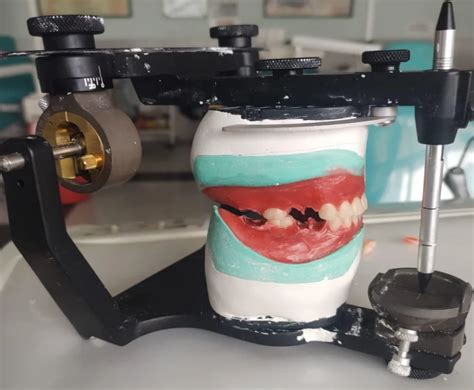 Mandibular Premolar Crisis|SDCINDIA