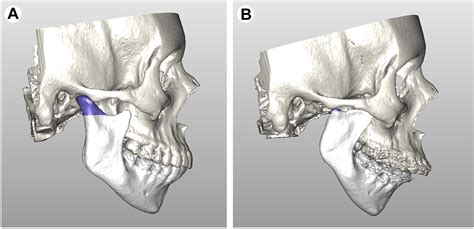 Histopathology of Idiopathic Condylar Resorption Differs From Temporomandibular Joint-Only ...
