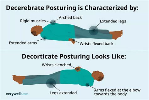 Image result for Decorticate Posture