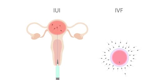 The Differences Between IUI and IVF | Similarities Between IUI and IVF