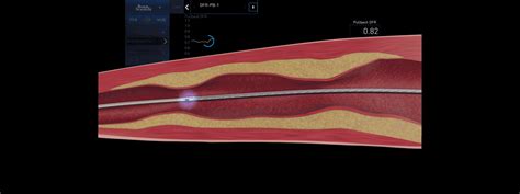 AVVIGO™+ - Boston Scientific