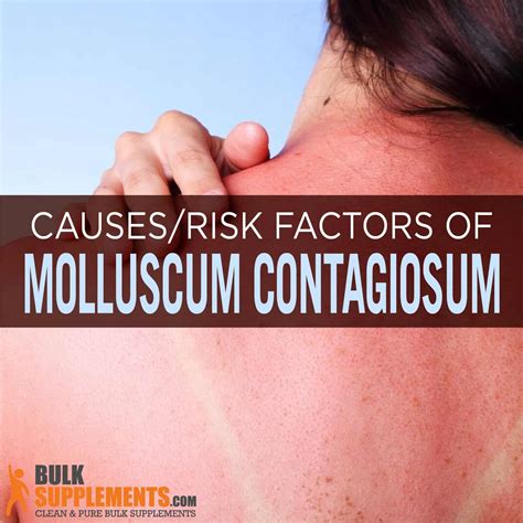 Molluscum Contagiosum: Symptoms, Causes & Treatment