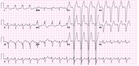 Image result for AFib Detection Algorithm