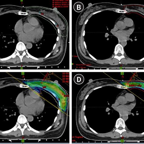 What Is CT Simulation 的图像结果