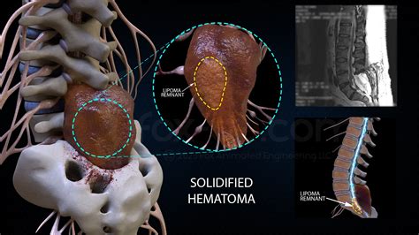 Growth of a Spinal Hematoma | Fox Animated Engineering