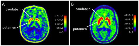 Dopamine Synthesis in the Nigrostriatal Dopaminergic System in Patients at Risk of Developing ...