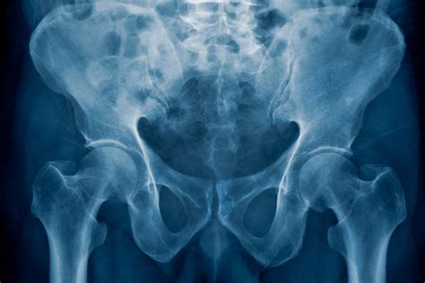 Young Female Pelvis X Ray Normal