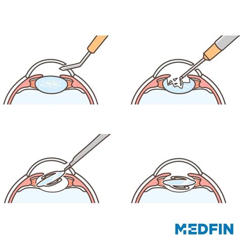 Femtosecond assisted Laser Cataract Surgery
