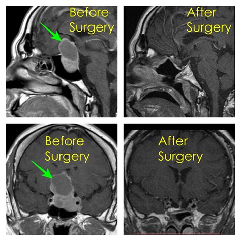 Endoscopic Pituitary Surgery Johannesburg