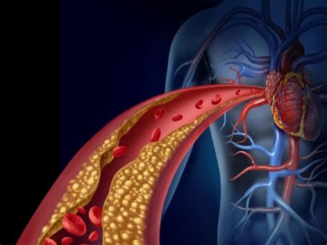 Bad Foods For Cholesterol: ఈ ఫుడ్స్ తింటే.. కొలస్ట్రాల్ పెరిగి ...