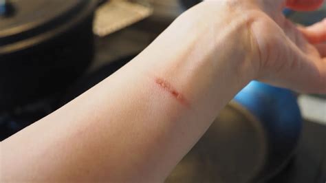 Why Does Skin Shed After A Kitchen Burn? Expert Answers