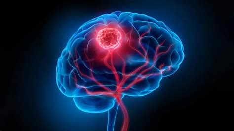 Brain cancer may begin years before doctors can see it | ScienceDaily