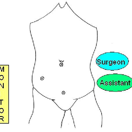 Image result for Normal Looking Appendix