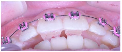 Patient Satisfaction with Anterior Bite Turbos: A Prospective Clinical ...