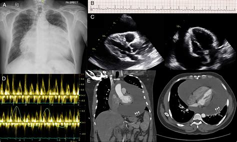 Massive Pericardial Effusion with Cardiac Tamponade | Medicina Intensiva