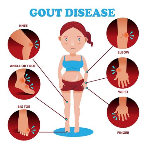 Can Graves Disease Cause Gout at Rachel Vance blog