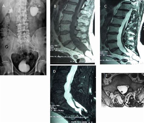 Late Clinical Presentation of Tethered Cord Syndrome
