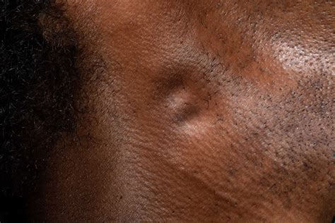 Understanding the Link: Can Allergies Really Cause Swollen Lymph Nodes? - Flash Uganda Media