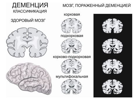 Деменция: что это за болезнь, симптомы, причины, признаки, лечение ...