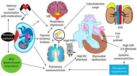 Meconium Aspiration Syndrome, Hypoxic-Ischemic Encephalopathy and ...