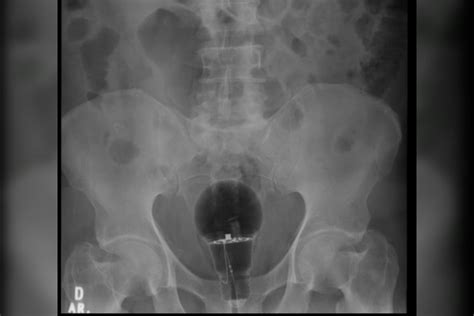 Paciente passa por procedimento para retirar lâmpada do ânus | Metrópoles