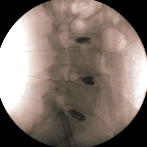 Image result for Lumbar Discogram