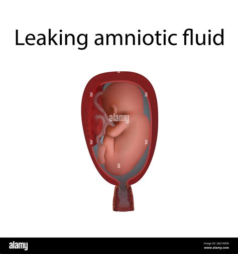 Amniotic fluid hi-res stock photography and images - Alamy