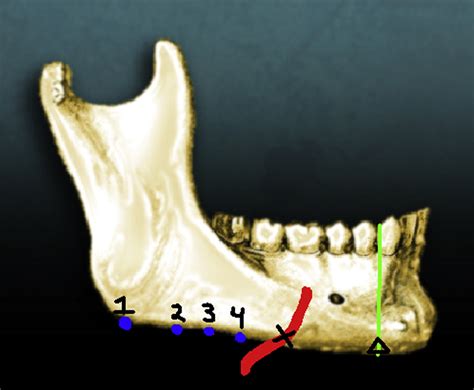 Facial Nerve Mandible
