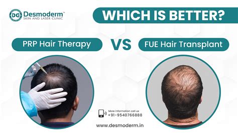 PRP Hair Therapy vs. FUE Hair Transplant and cost in Delhi | Desmoderm