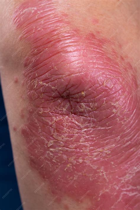 Premium Photo | Unrecognizable man feel bad on skin disease called ...