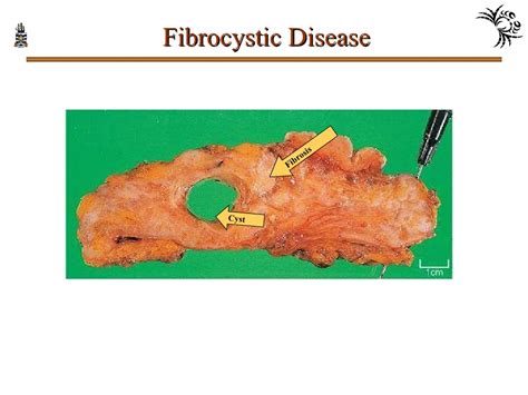 Bluedomed Cyst Fibrocystic Disease