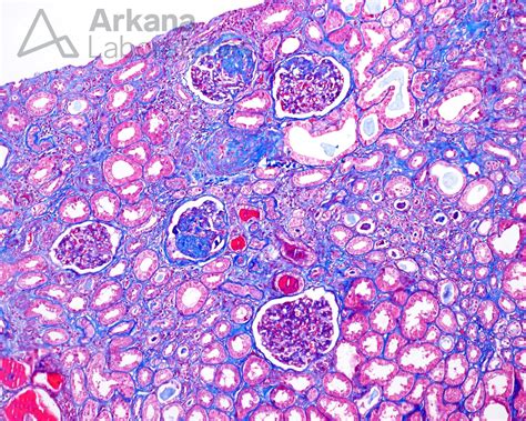 Focal and Segmental Glomerulosclerosis | Diagnose This! | Arkana Labs