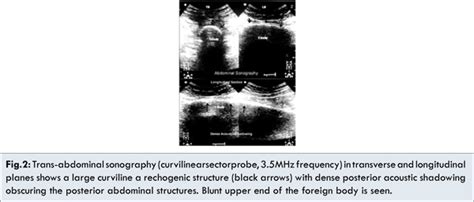Abnormally Large Wooden Foreign Body Impacted in the Rectosigmoid Colon ...