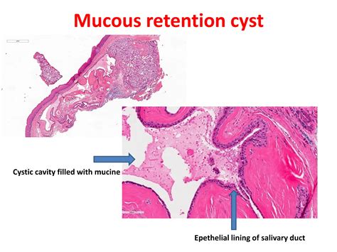 Mucous Retention Cyst
