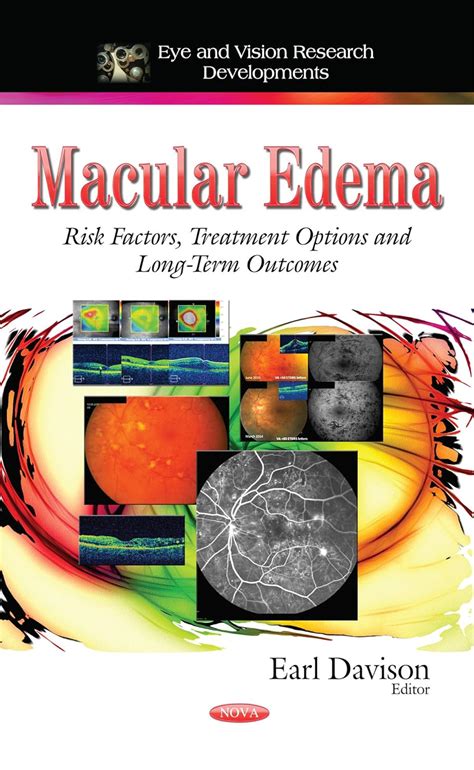 Buy Macular Edema: Risk Factors, Treatment Options and Long-Term ...