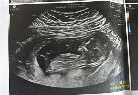 13 Week Fetus Ultrasound