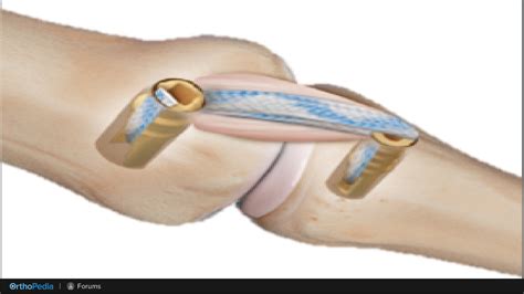 Hand and Wrist Fellowship Forum: Thumb UCL Repair