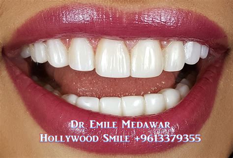 Direct Veneers | Composite Veneers Lebanon