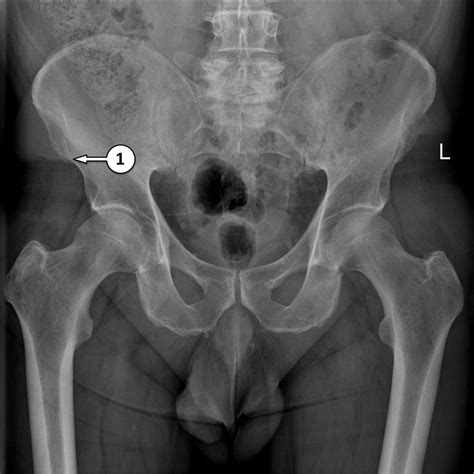 What Does A Shadow On A Hip X Ray Mean at Tammy Jackson blog