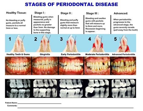 stages of peridontal disease Periodontal stages perio dental gums ...